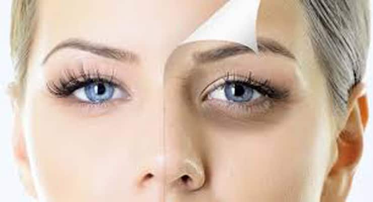 Tips to get ride of eye bags and dark circles