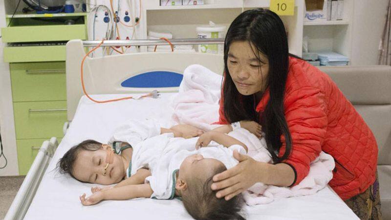 Conjoined twin babies... six-hour surgery