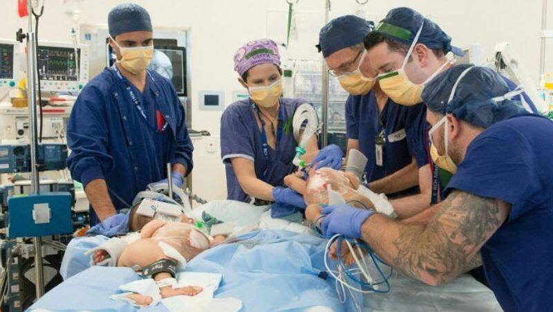 Conjoined twin babies... six-hour surgery