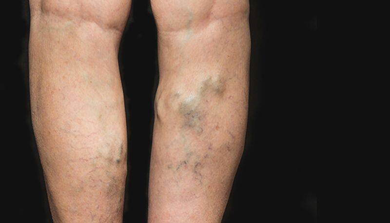 varicose vein; causes and treatment