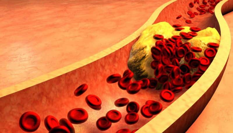 Most Effective Home Remedies for Cholesterol