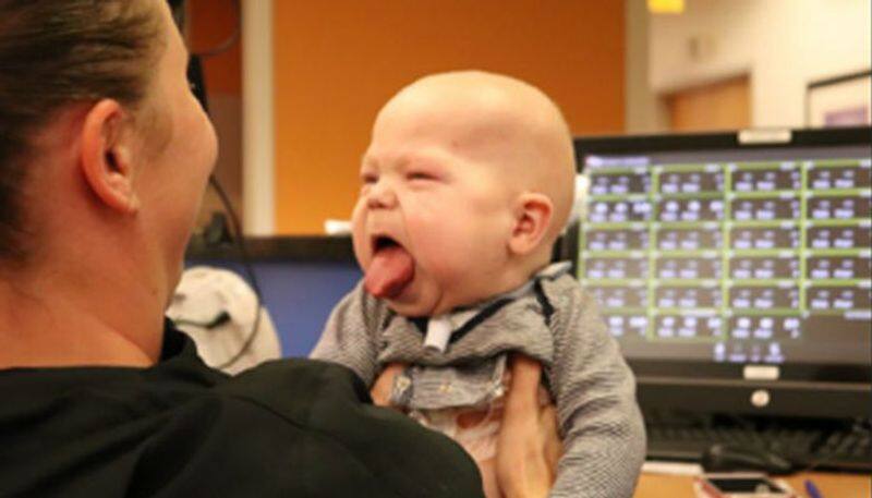 toddler who has a double sized tongue due to rare disease