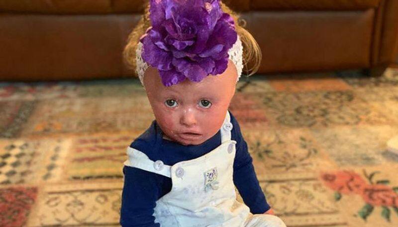 girl child who suffers from rare skin disease