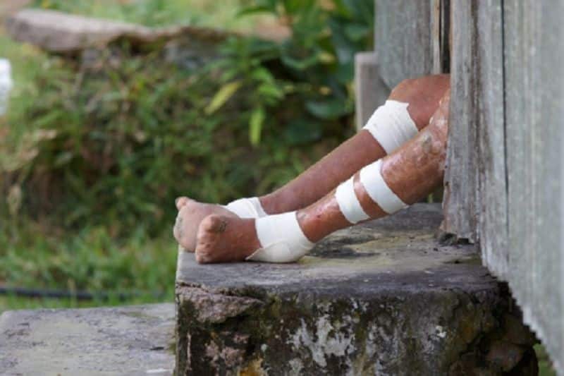 World Leprosy Day India battling over 1 lakh cases WHO eliminating prejudice