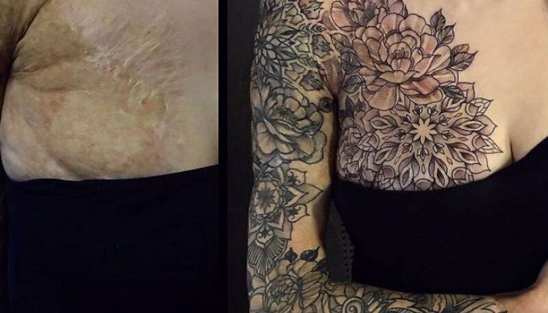 tattoo on wound scars and surgery scars