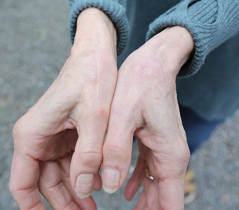 An elderly woman who can't feel pain due to genetic mutation stuns the researchers