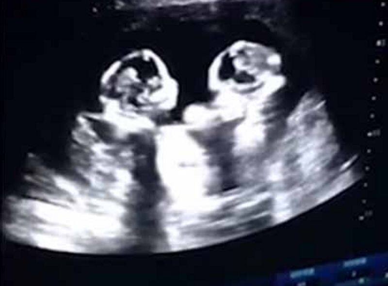 2 kids fighting in mothers uterus watch viral video here