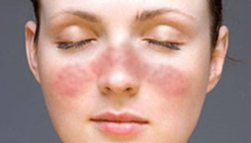 signs and symptoms of lupus disease