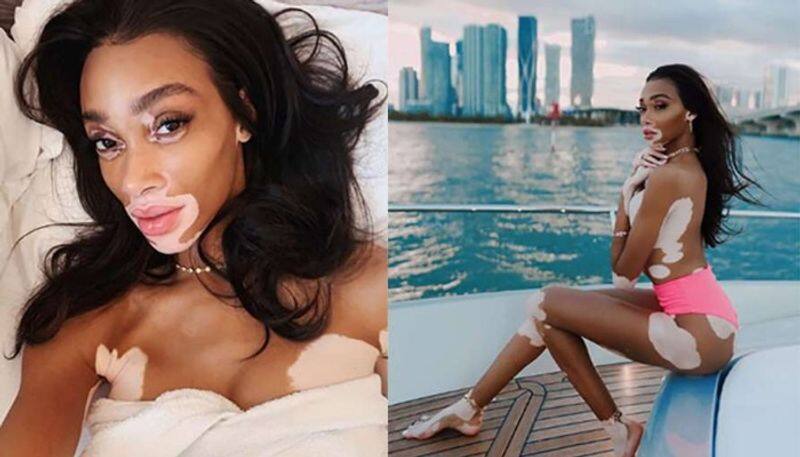 Winnie Harlow is an inspiration to all women