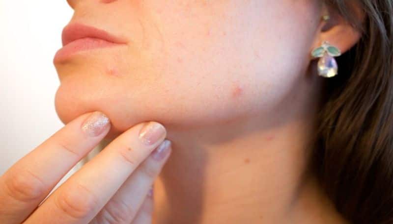 know the reasons behind acne and here are some tips to fight against acne