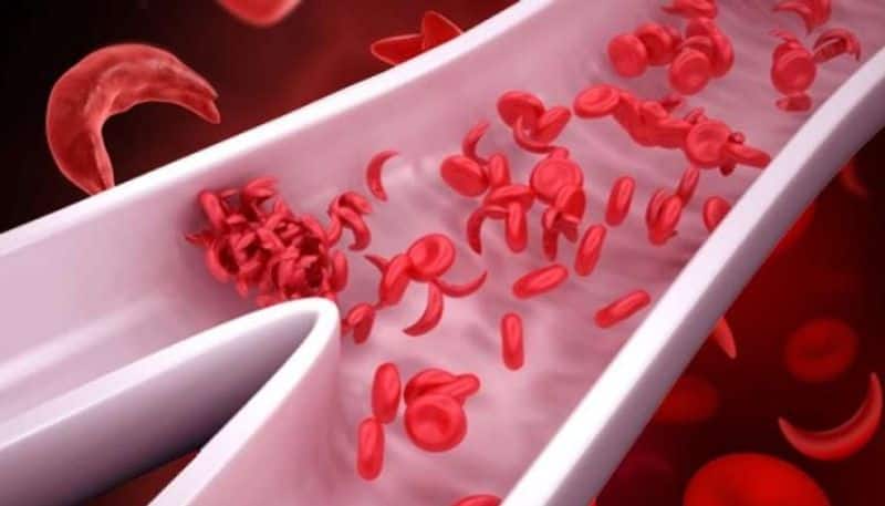 anaemia cases are increasing in india says nfs report