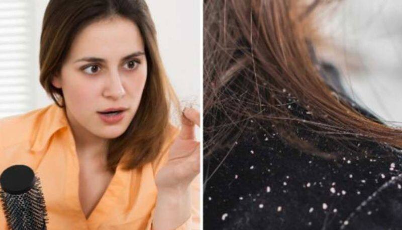 how to control dandruff