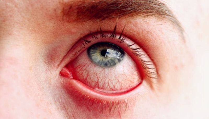 madras eye disease spreads in chennai