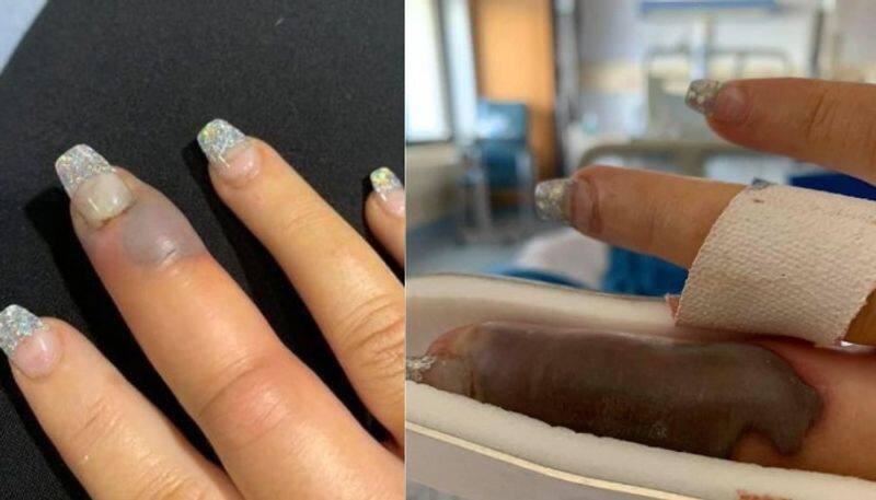 Woman s finger swelled after getting a salon manicure