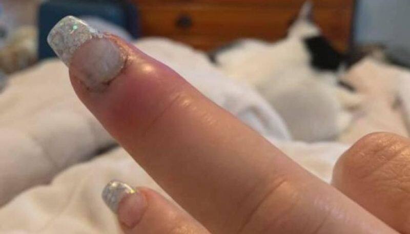 Woman s finger swelled after getting a salon manicure
