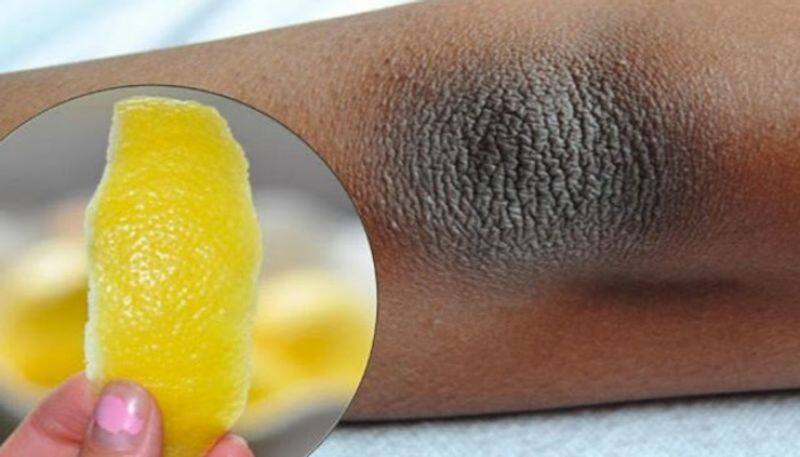how to get rid of dark elbows and knees naturally