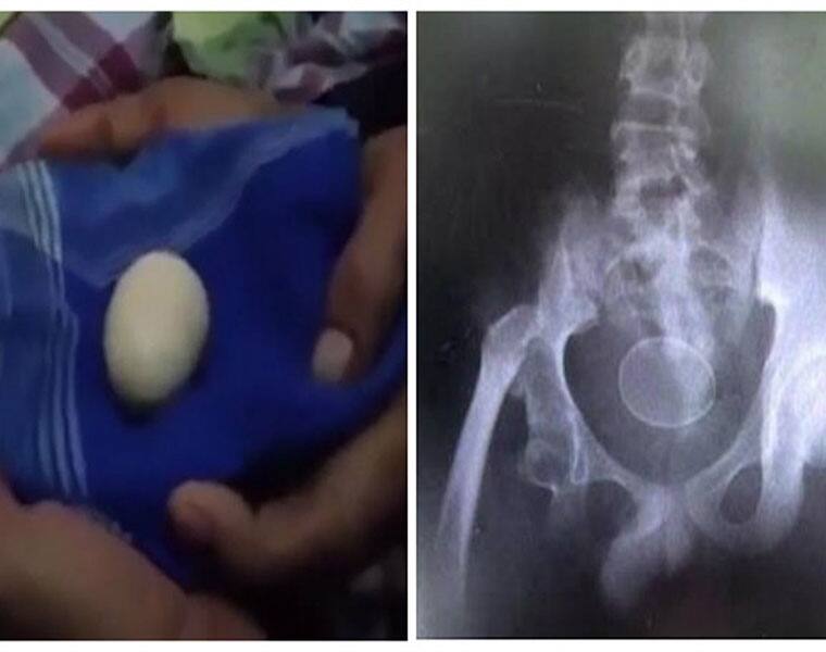 Indonesian boy claims to have laid 20 eggs