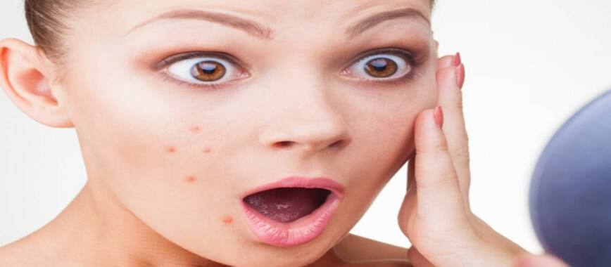 how to control pimples in simple way