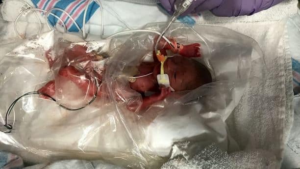 Preemie baby placed in plastic bag survives