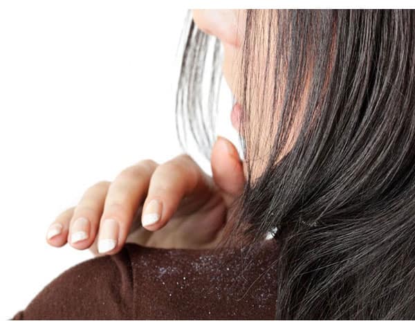 we can prevent dandruff by using apple