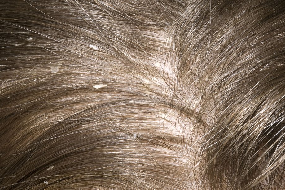 suffering from dandruff problem use effective home remedies to prevent naturally BDD