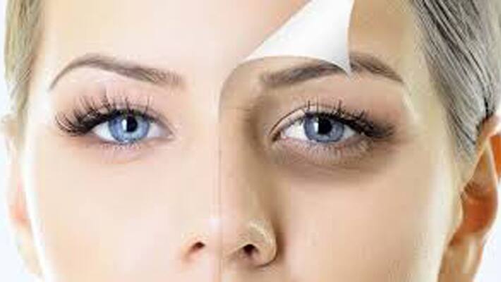 Know about the causes of dark circles and home remedies treatment Know about the causes of dark circles and home remedies treatment