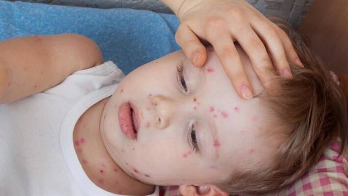 how to identify if your baby suffered from Chicken pox BRD how to identify if your baby suffered from Chicken pox BRD