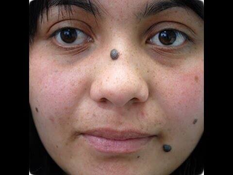 this is the best method to remove black mark from face