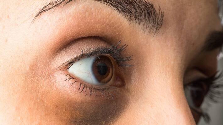 how to remove dark circles under eyes how to remove dark circles under eyes