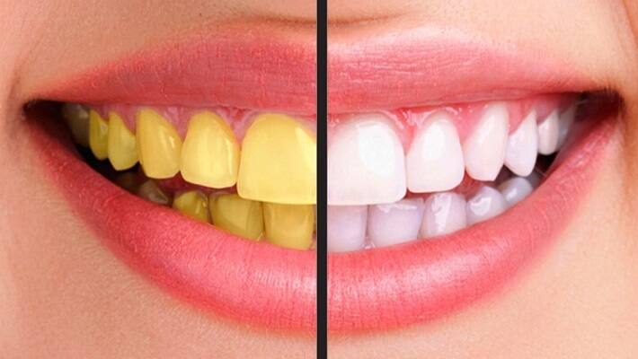 Effective home remedies to remove plaque and tartar from teeth BDD Effective home remedies to remove plaque and tartar from teeth BDD