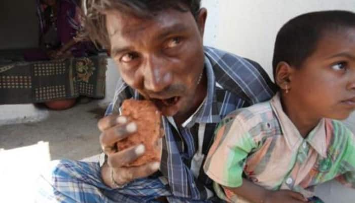 Man Who Eats 3 Kg Of Mud, Rocks And A Brick Every Day