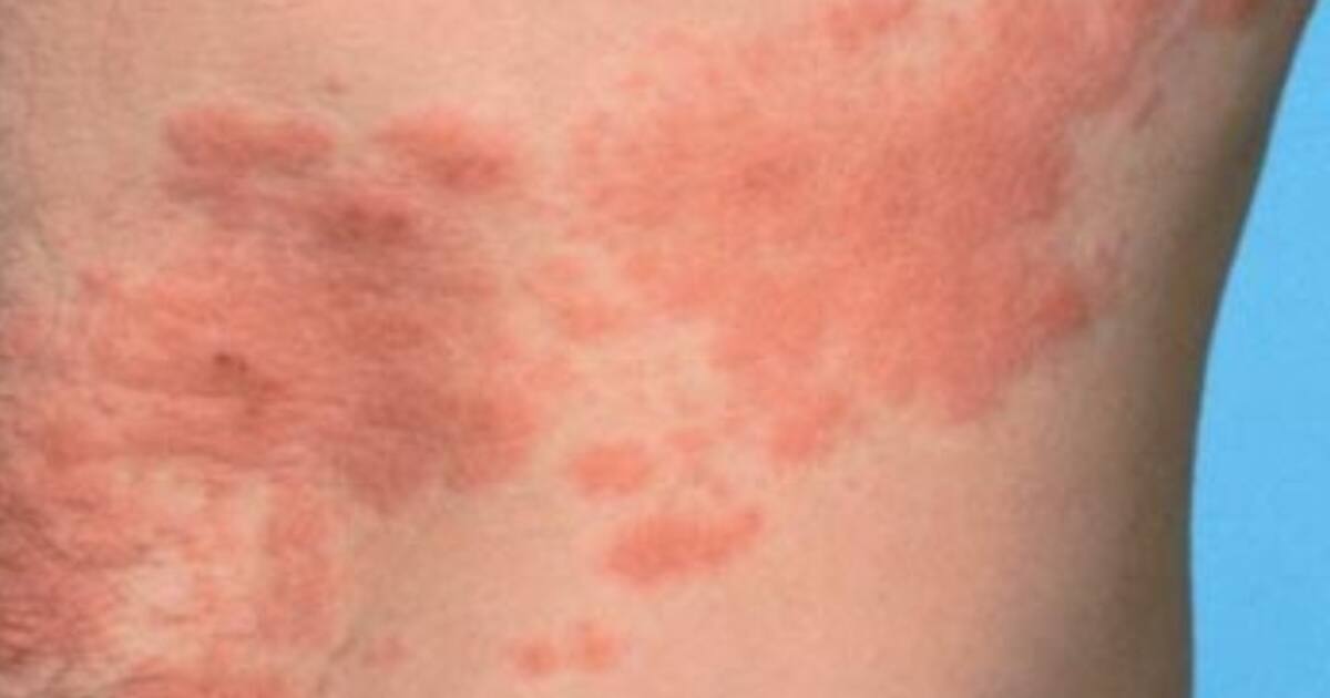 Snake Skin Rash ಸರ್ಪಸುತ್ತು ಬರಲು ಕಾರಣ ನಾಗದೋಷವಲ್ಲ ಈ ವೈರಸ್!