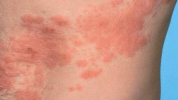 Cause of Herpes on human skin Cause of Herpes on human skin