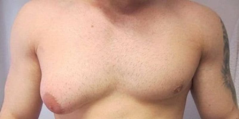 Not only women men too face breast cancer