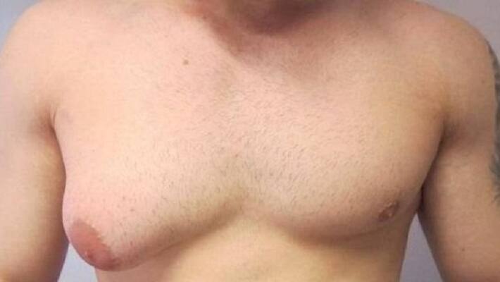 Reason for enlarged breast in men Reason for enlarged breast in men