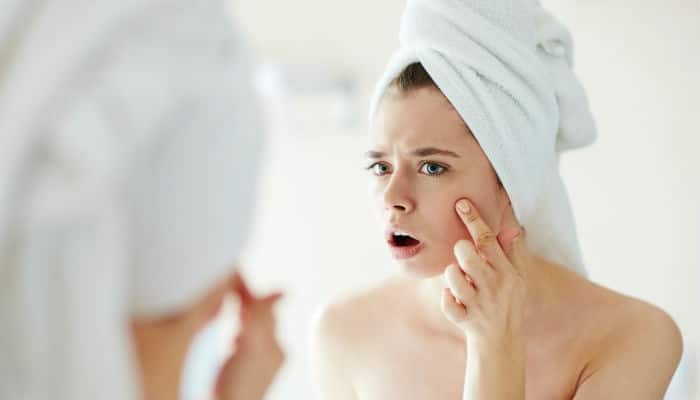 simple solutions to cure acne marks from face