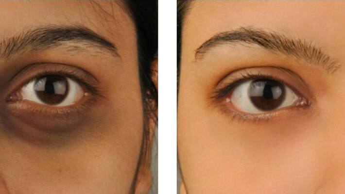 how to get rid from dark circles under eyes how to get rid from dark circles under eyes