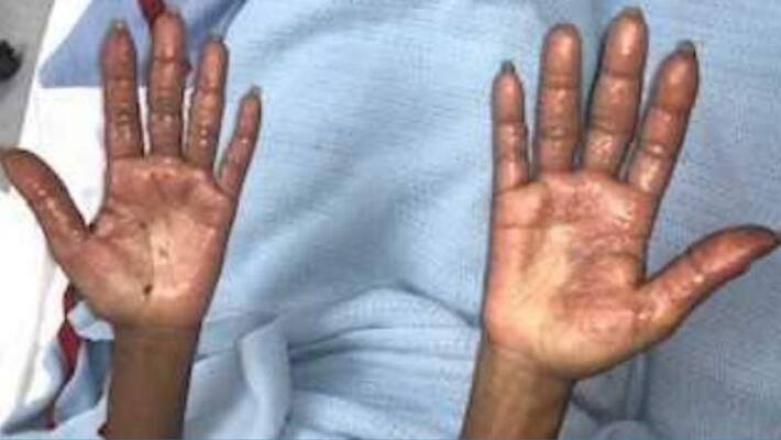 expat suffers burns while using hair dye in UAE expat suffers burns while using hair dye in UAE