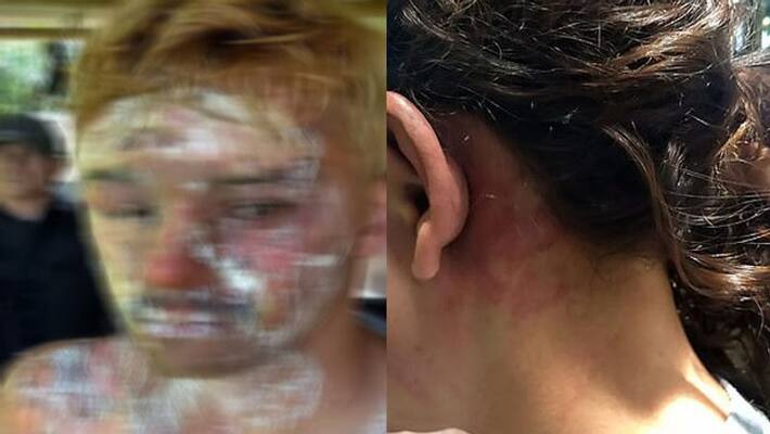 wife throws hot water on husband in vijayawada wife throws hot water on husband in vijayawada
