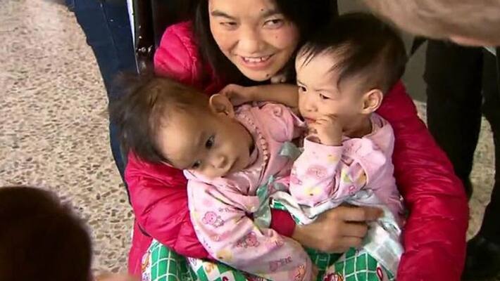 Conjoined twin babies... six-hour surgery Conjoined twin babies... six-hour surgery