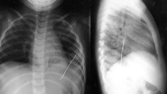 doctors extract 3.5-cm pin from teens lungs doctors extract 3.5-cm pin from teens lungs