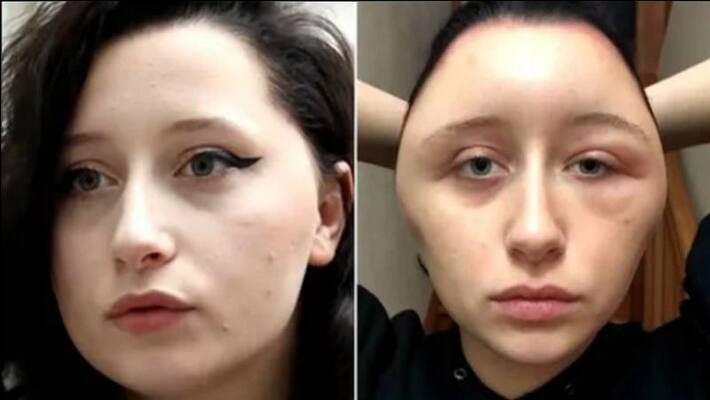 Hair dye cause serious allergy on girl Hair dye cause serious allergy on girl