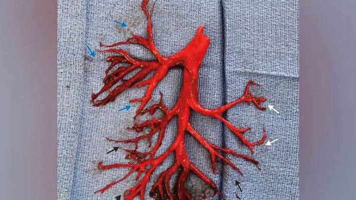 man coughed blood clot which exactly same of his lung passage man coughed blood clot which exactly same of his lung passage