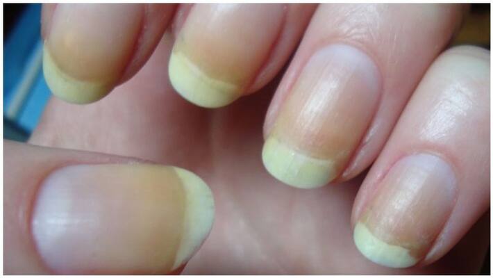 if our nail colour changed we have to notice the problem asap if our nail colour changed we have to notice the problem asap