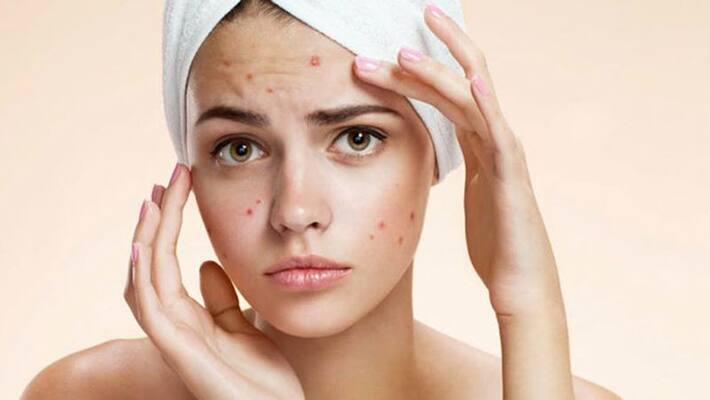 this is the best method to prevent pimples this is the best method to prevent pimples