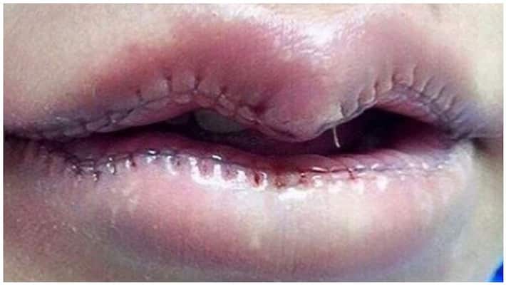 actress sara khan plastic surgery for lips actress sara khan plastic surgery for lips