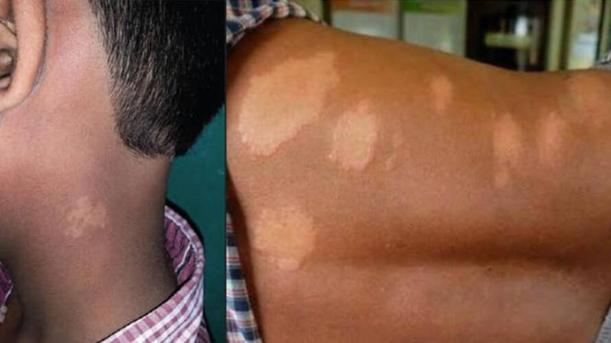 World Leprosy Day 2023 signs and symptoms of Leprosy World Leprosy Day 2023 signs and symptoms of Leprosy