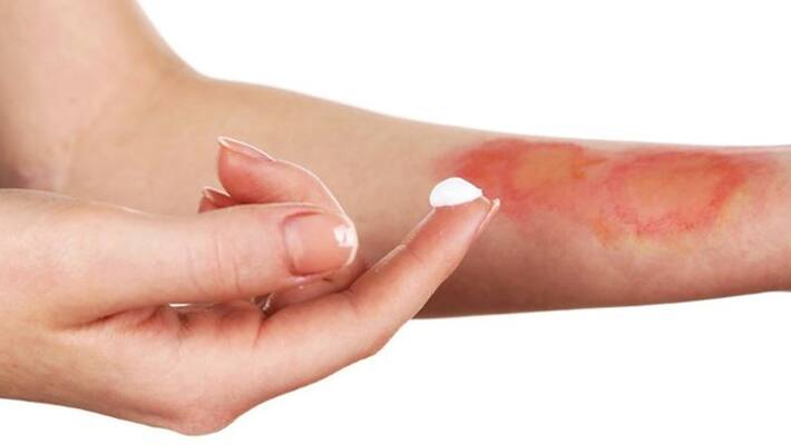 How can burn injuries be prevented How can burn injuries be prevented