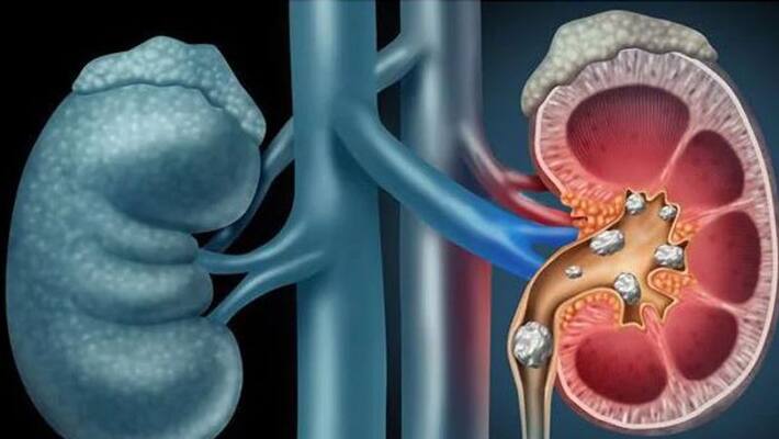 7 Home Remedies To Dissolve Kidney Stones Naturally bpsb 7 Home Remedies To Dissolve Kidney Stones Naturally bpsb