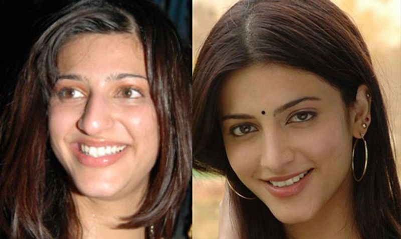 శ్రుతి హాసన్ - నోస్, లిప్ జాబ్